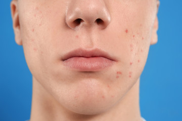 Obraz premium Teen guy with acne problem on blue background, closeup