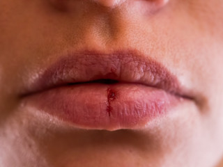 Close-up pale female lips cracked from frost, wind, lack of vitamins. Herpes disease virus wound. Lips need hygiene. Mature woman 35 years oldsuffering from herpes