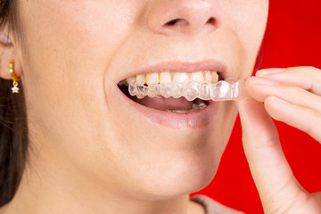 Woman wearing orthodontic silicone corrector. Invisible braces aligner. Style and beauty concept.