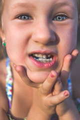 Little girl with orthodontics appliance and crooked teeth. Wobbly tooth.