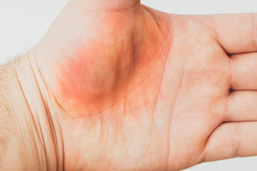 trauma to the palm close-up, bruise