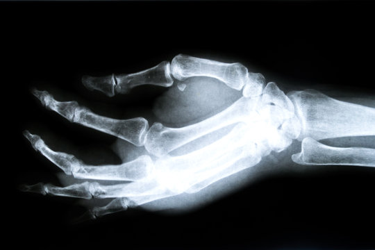 X-Ray image of human hands
