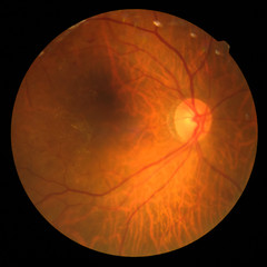 Photo Madical Retina Abnormal isolated on black background.Retina of diabetes , diabates retinopathy. - obrazy, fototapety, plakaty