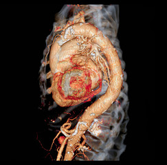 CTA thoracic aorta  3D rendering image for  diagnotic abdominal aortic aneurysm or AAA and aortic dissection