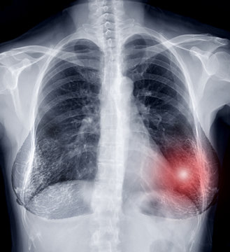 Chest X-ray or X-Ray Image Of human Chest