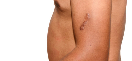Fototapeta na wymiar Scar on skin , Men don't wear clothes has Keloid on his arm. Isolated on white for text. Can used for imperfections of body concepts