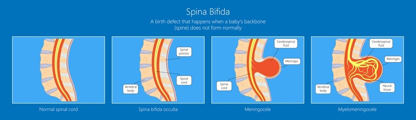 Spina bifida birth defects infant disease