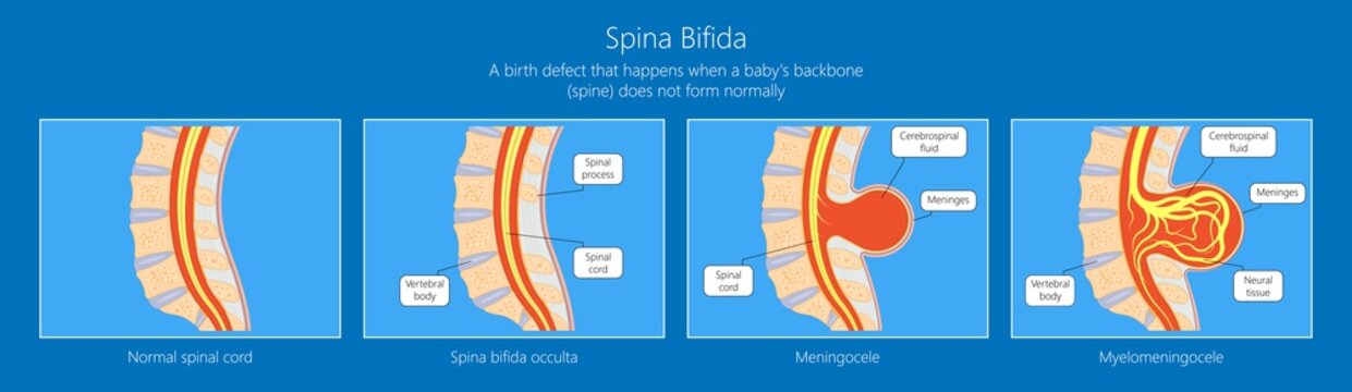 Spina Bifida Birth Defects Infant Disease