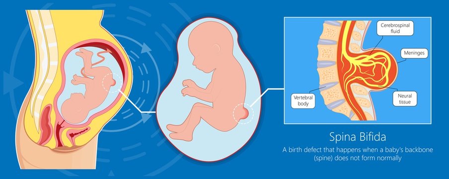 Spina Bifida Birth Defects Infant Disease