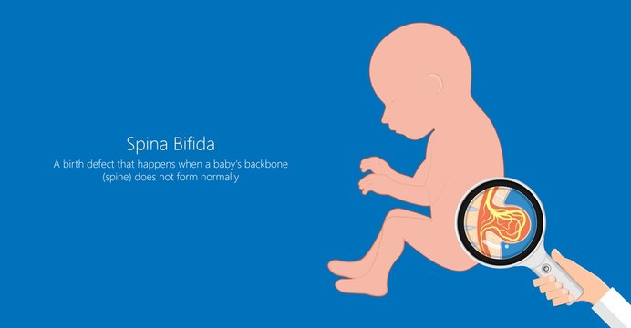 Spina bifida birth defects infant disease