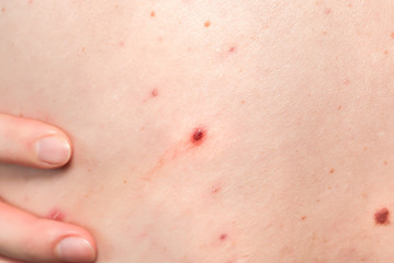 Fototapeta premium Many birthmarks on the girl's back. Medical health photo. Woman's oily skin with problems acne.