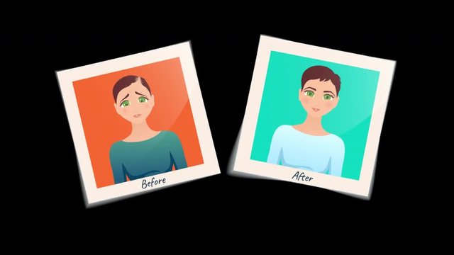 Woman before and after hair transplantation treatment. Cartoon animation of two pictures. Female hair loss motion design graphics with alpha channel. Alopecia medical concept. 