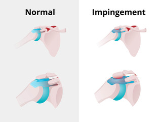 Normal shoulder and impingement. Illustration of the normal shoulder anatomy and impingement disorder