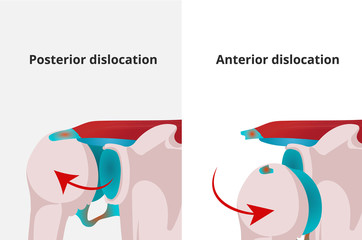 Anterior and posterior shoulder dislocation vector illustration