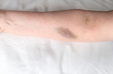 Intravenous injection treatment. Woman's hand on a white sheet with hematomas and traces of...