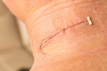 Suture after surgery on the human neck. Stitched wound after surgery. Close up.