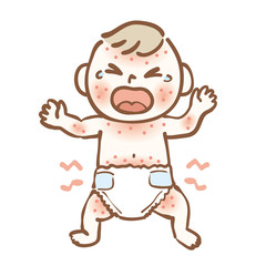 Illustration of a baby with infant eczema