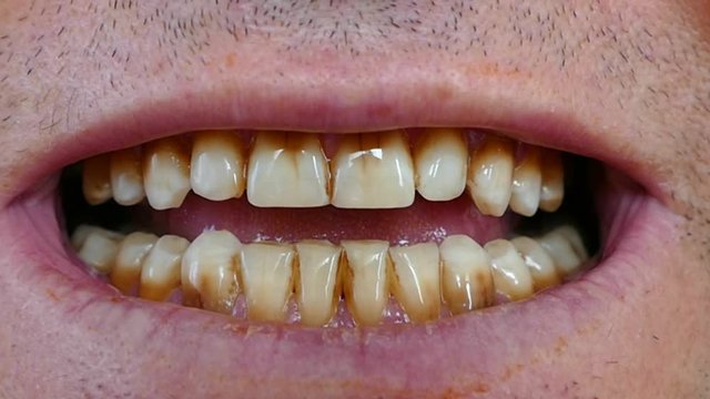 neglected mouth and yellowed teeth of a person, coffee and yellowed teeth