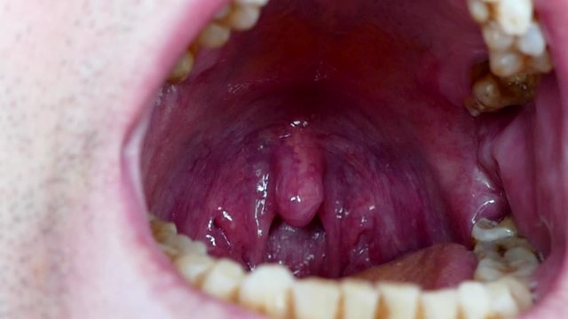small tongue and tonsils, a person's mouth, neglected mouth, small tongue and tonsils of a person,