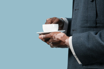 Close up of male hands with vitiligo pigments isolated on blue studio background. Wearing office attire, workwear. Special skin. Holding cup. Business, finance, advertising concept. Copyspace.