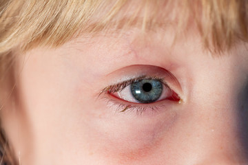 Fototapeta premium Closeup of irritated red bloodshot eye - conjunctivitis