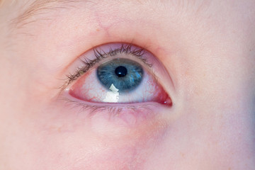 Obraz premium Closeup of irritated red bloodshot eye - conjunctivitis