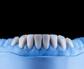 planning and making press ceramic veneers