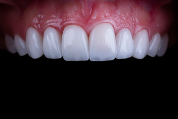 planning and making press ceramic veneers