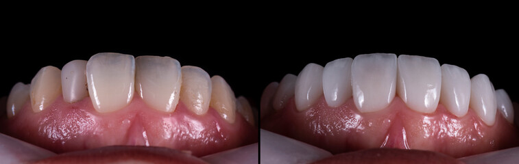 planning and making press ceramic veneers