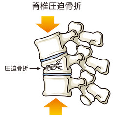 骨折がある脊椎　圧迫骨折