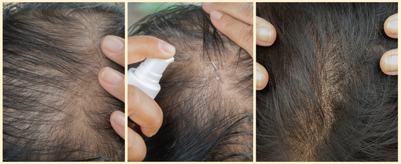 Before and after thin and thick hair, the hair roots are dense.