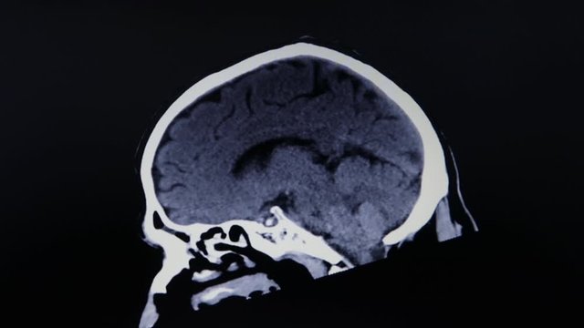 CT Scan head Sagittal footage