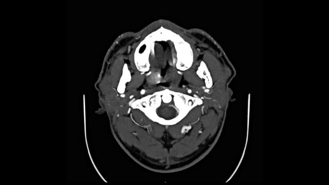 Computed tomography angiography (CTA) of your brain. Axial mip view. 