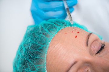 PRP Face Injecting Treatment. Anti-Aging Face Treatment.