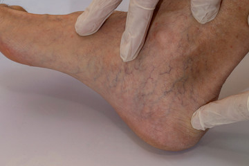 Symptoms of varicose veins disease. Similar patterns appear on the feet of the elderly