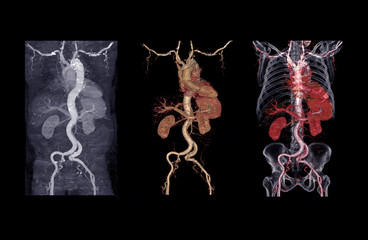  collection of CTA abdominal aorta 3D rendering image showing aortic dissection .