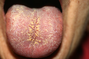 Thrush on the tongue. Geographic tongue. Candidiasis.