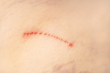 Skin damage, macro: scratch, stretch marks, age spots. Texture of damaged skin