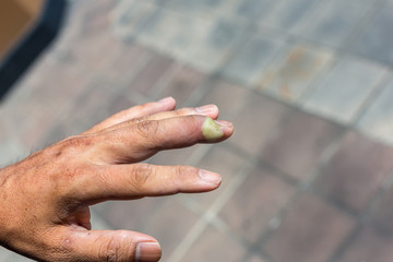 Paronychia, swollen finger with fingernail bed inflammation due to bacterial infection on a toddlers hand