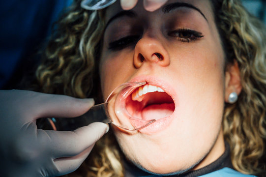 Young woman getting braces put on teeth