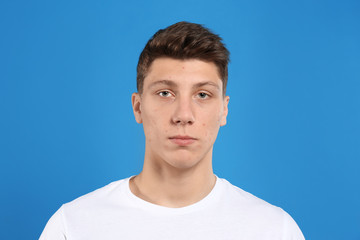 Fototapeta premium Teen guy with acne problem on blue background