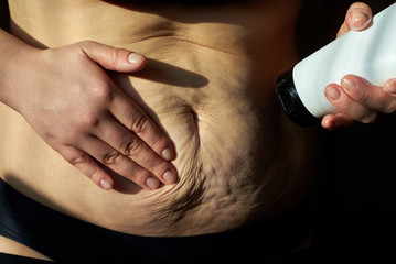 Woman smears cream sagging flabby belly with stretch marks.