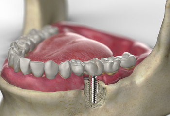 Closeup view of molar teeth dental implant in detail angled view 3d render