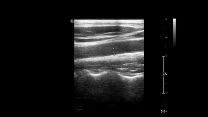 Ultrasound examination of blood vessels in grayscale mode.