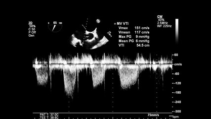 Obraz premium Image of the heart in gray-scale mode during transesophageal ultrasound.