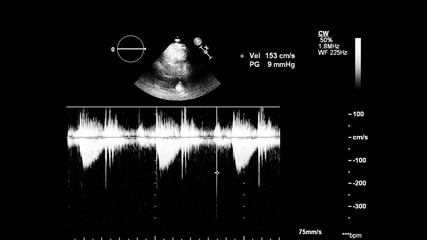 Image of the heart in gray-scale mode during transesophageal ultrasound.