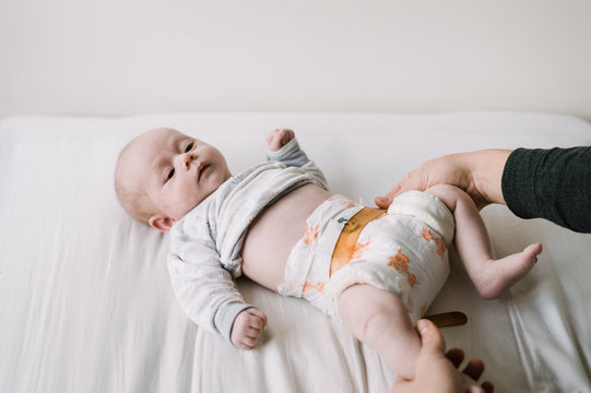 Baby with Hip Dysplasia