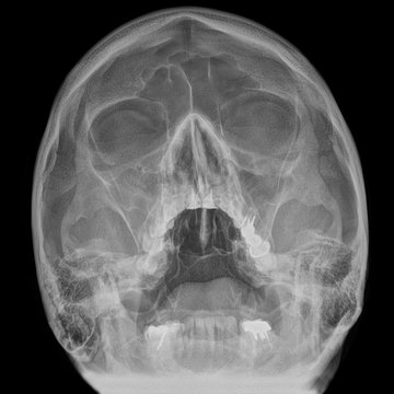 Adult skull radiography
