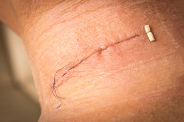 Suture after surgery on the human neck. Stitched wound after surgery. Close up.
