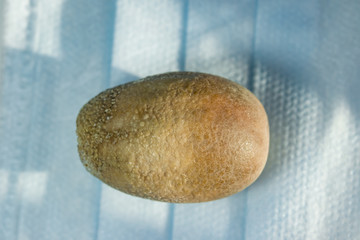 Large stone from the gallbladder, the size of 4 centimeters, formed in the disease calculous cholecystitis, cholelithiasis